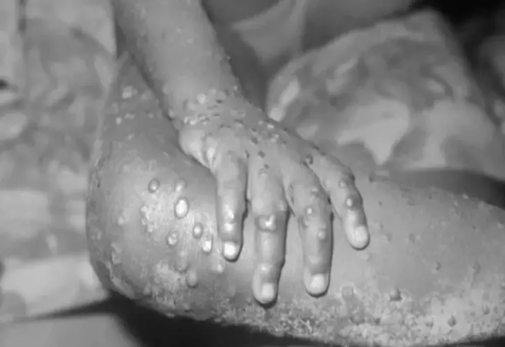 Două noi cazuri de variola maimuţei au fost confirmate în România